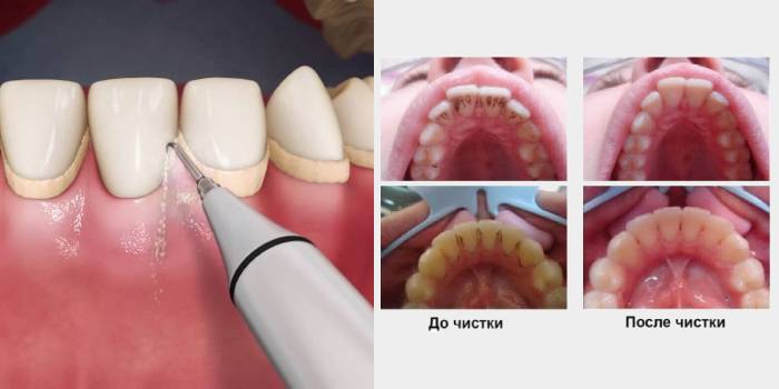 Siêu âm đánh răng
