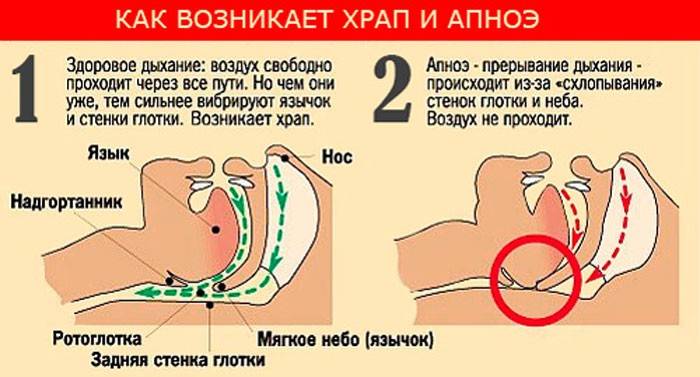 Причини за хъркане и апнея