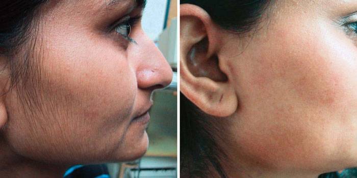 Épilation au laser sur le visage: avant et après les photos