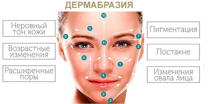 Na čo sa dermabrázia používa?