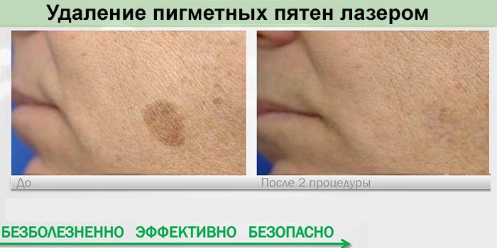 Výsledok odstránenia škvŕn laserom