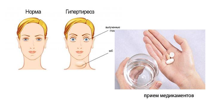 Causes de l'apparition des poils du visage chez les femmes