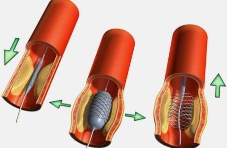 Vasküler stent
