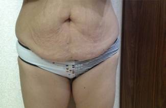 Auto-massage de l'abdomen