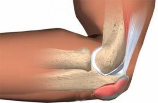 Epicondylitis ศอก