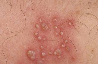 Herpes genital