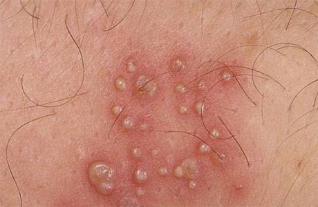 Herpes genitale