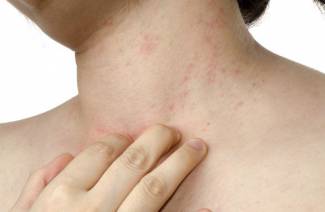 Ekzematöse Dermatitis