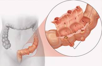 Traitement de la diverticulose intestinale