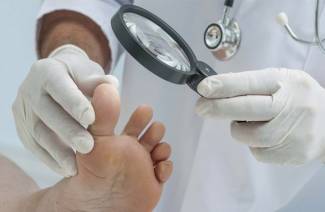 Irunin from nail fungus