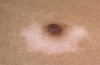 Nevus Settonas