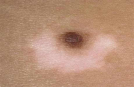 Nevus Setton