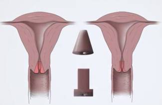 Conisation cervicale