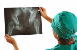 Coxarthrose 3 degrés