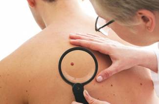 Pigmento nevus