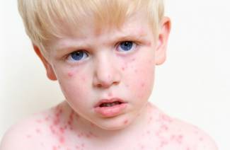 Lozione di varicella alla calamina