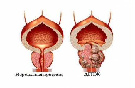 Hiperplazia prostatică