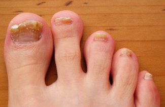 Creolin de mycose des ongles