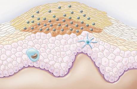 Condylomes chez les hommes