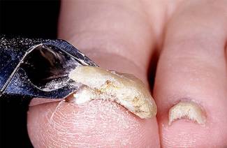 Traitement de onychomycose des ongles