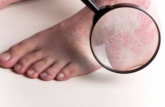 Traitement du psoriasis en Israël