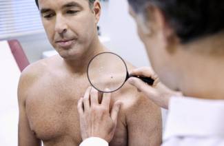 Che cos'è il papilloma
