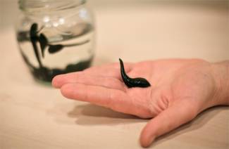 Hirudothérapie en gynécologie