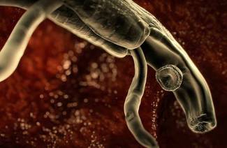 schistosomiasis
