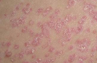 Le psoriasis est-il contagieux?