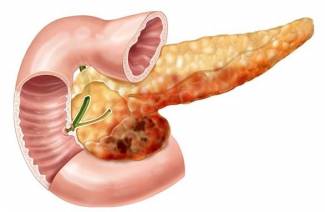 Pancreatita alcoolică