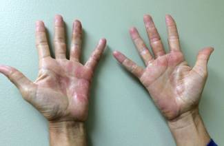 Kontaktdermatitis