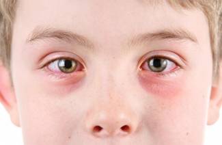 Conjuntivitis en un niño