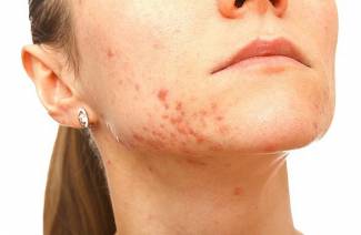 Psoriatic triad