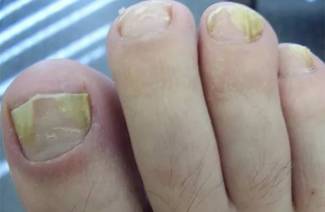 Comment guérir rapidement les champignons de l'ongle