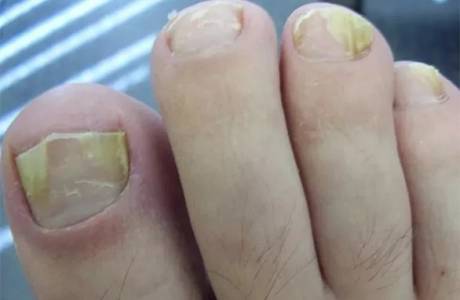Cách chữa nấm móng chân nhanh chóng