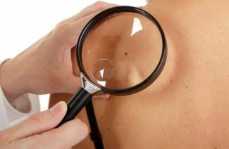 Nevus - ce este
