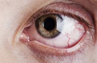 Cukrinio diabeto retinopatija