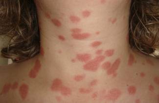 Taches rouges sur le corps