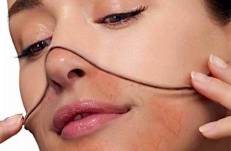 Yüzündeki rosacea için krem