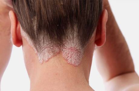 Tratamentul psoriazisului inițial
