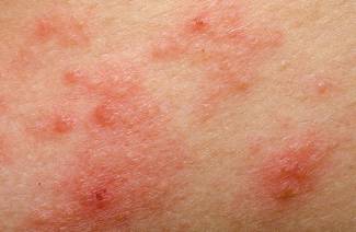 Traitement de l'eczéma