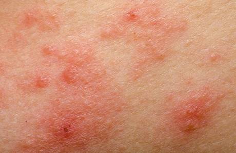 Traitement de l'eczéma