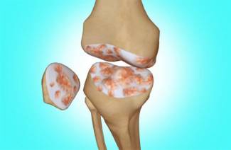Gonarthrose 3 Grad