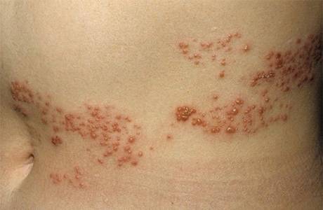 Herpes Zoster