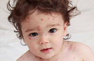 È possibile lavare con la varicella