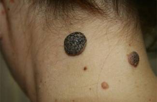 Papilomatinis nevus
