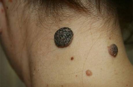 Papilomatinis nevus