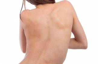 Scoliose