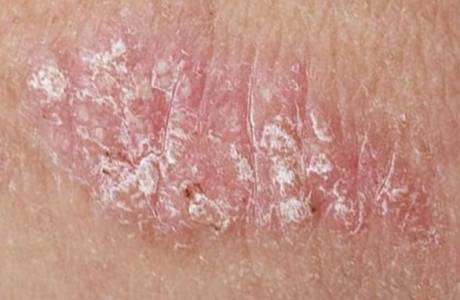 Gomba dermatitisz