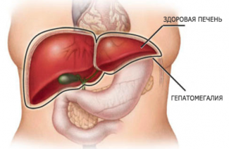 Hepatomegali nedir?